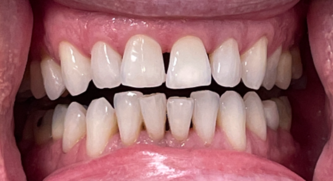Before - Londent Dental