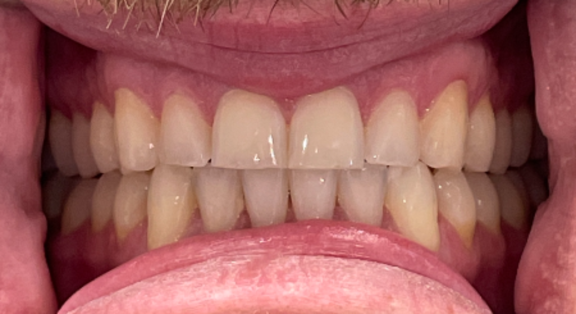 After - Londent Dental