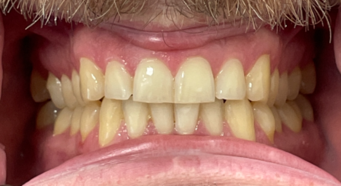 Before - Londent Dental