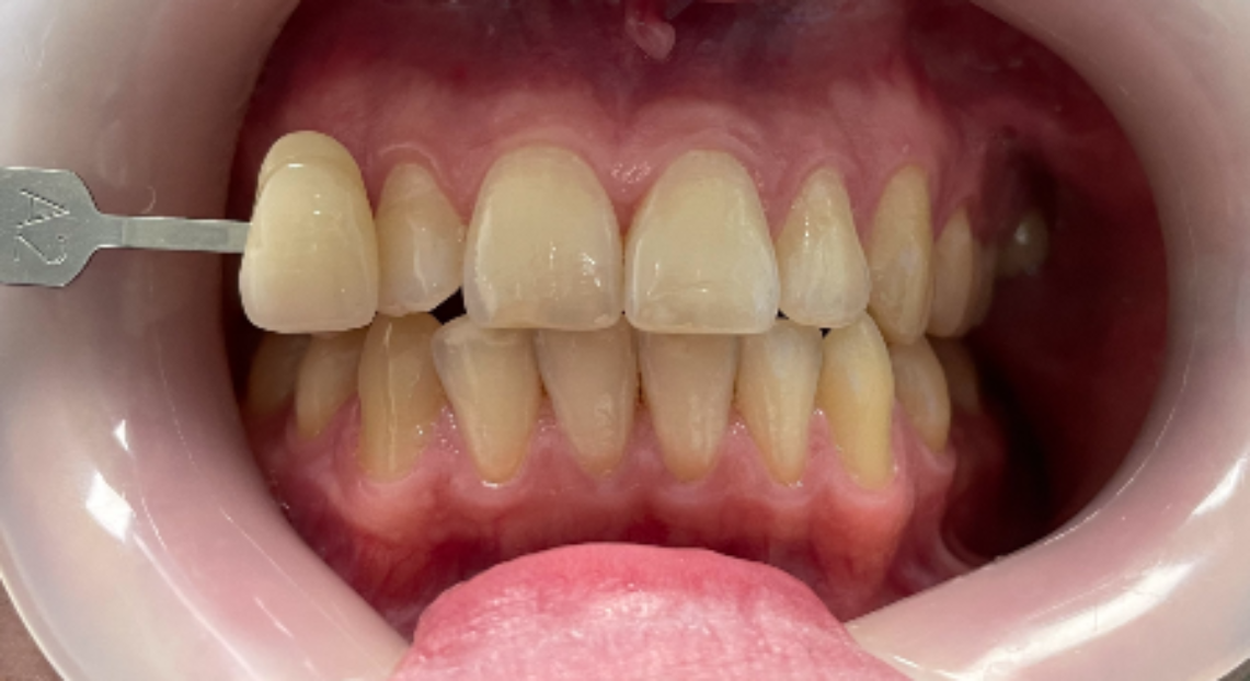 Before - Londent Dental