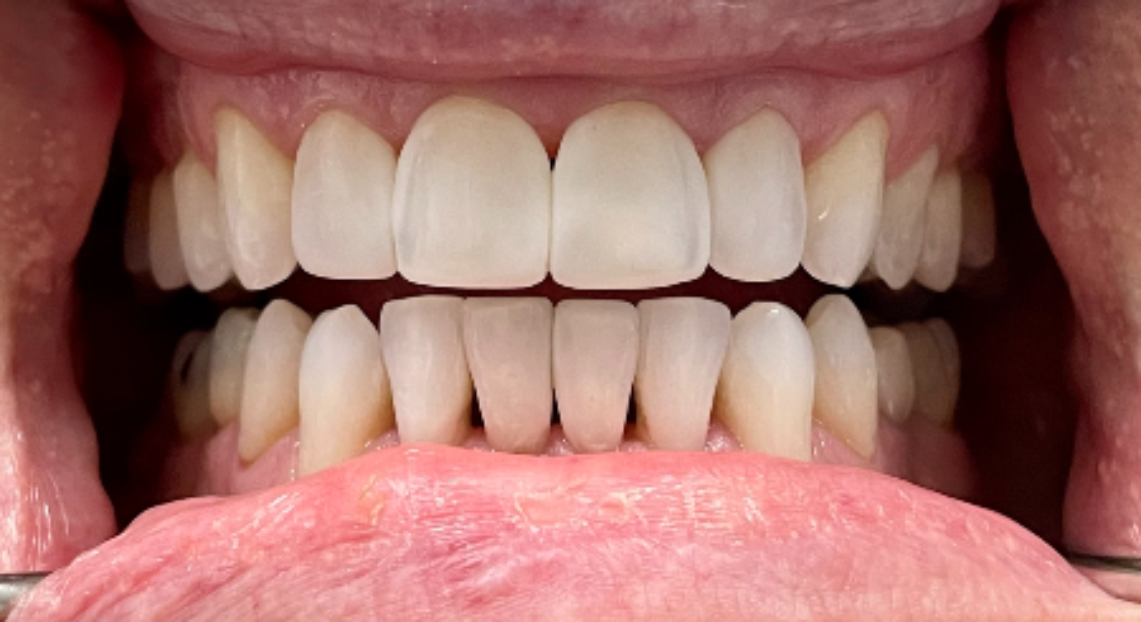 After - Londent Dental