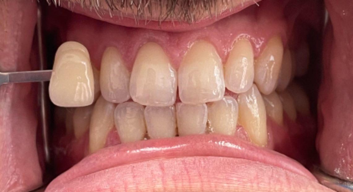 Before - Londent Dental