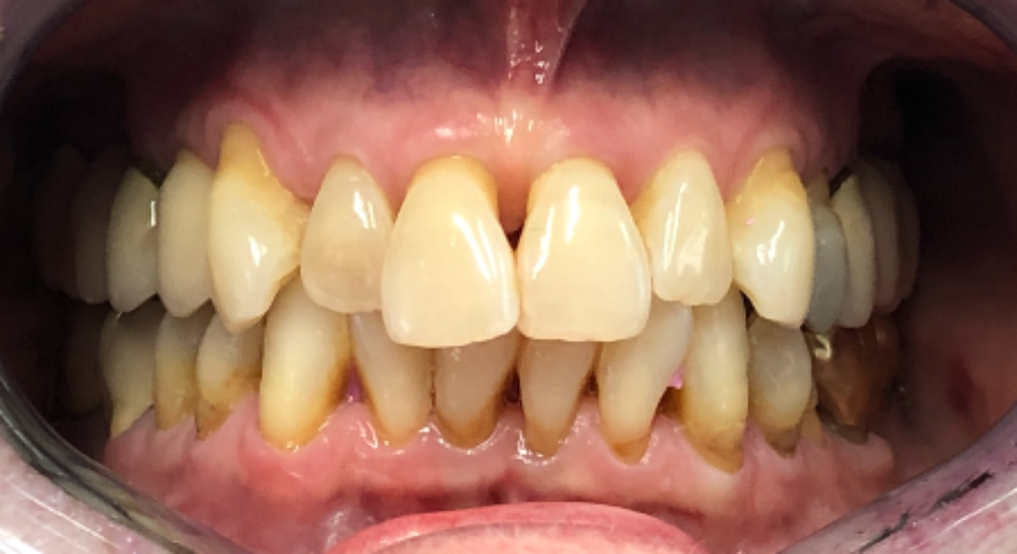 Before - Londent Dental