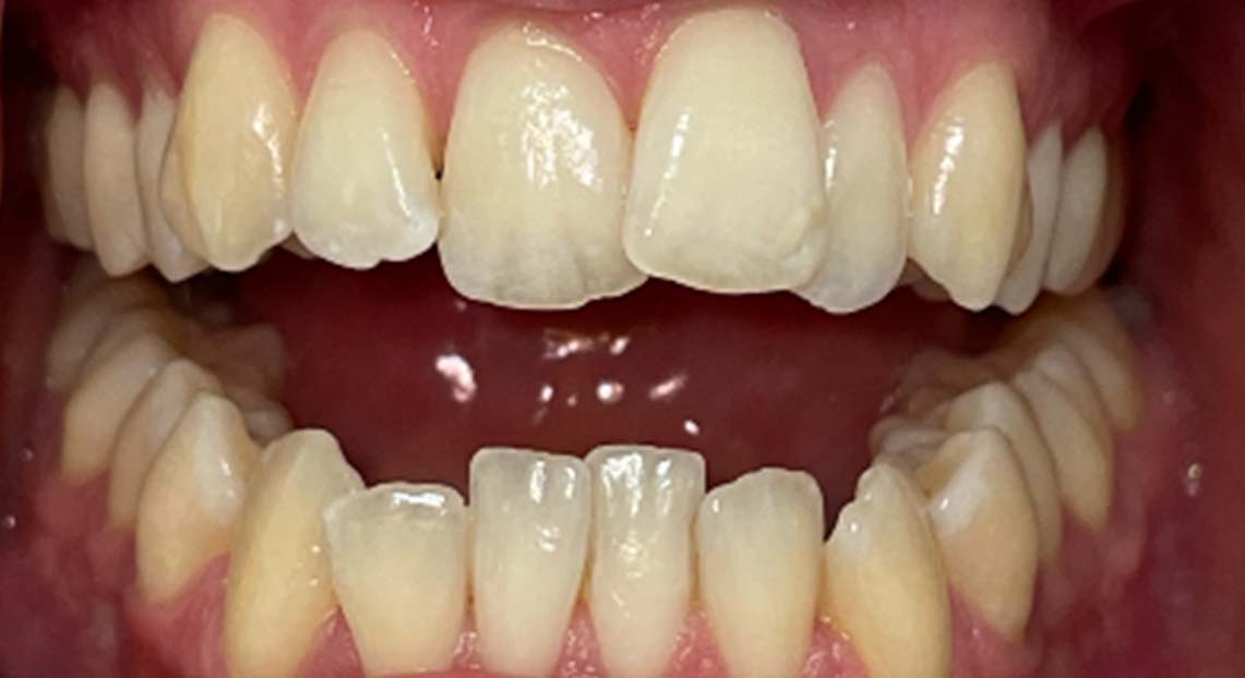 Before - Londent Dental