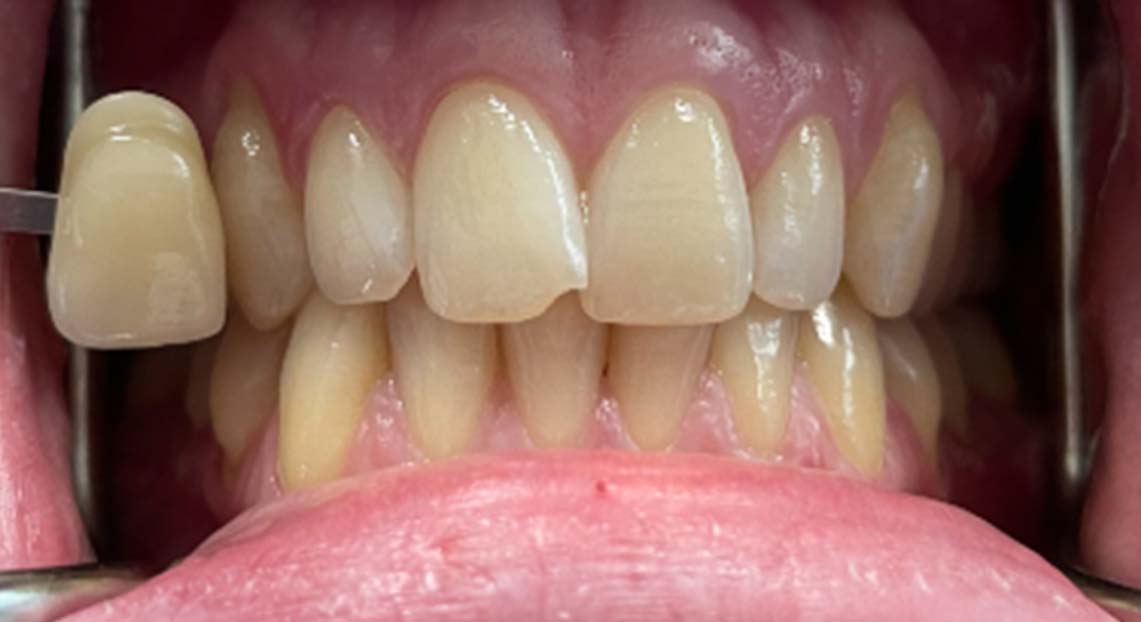 Before - Londent Dental