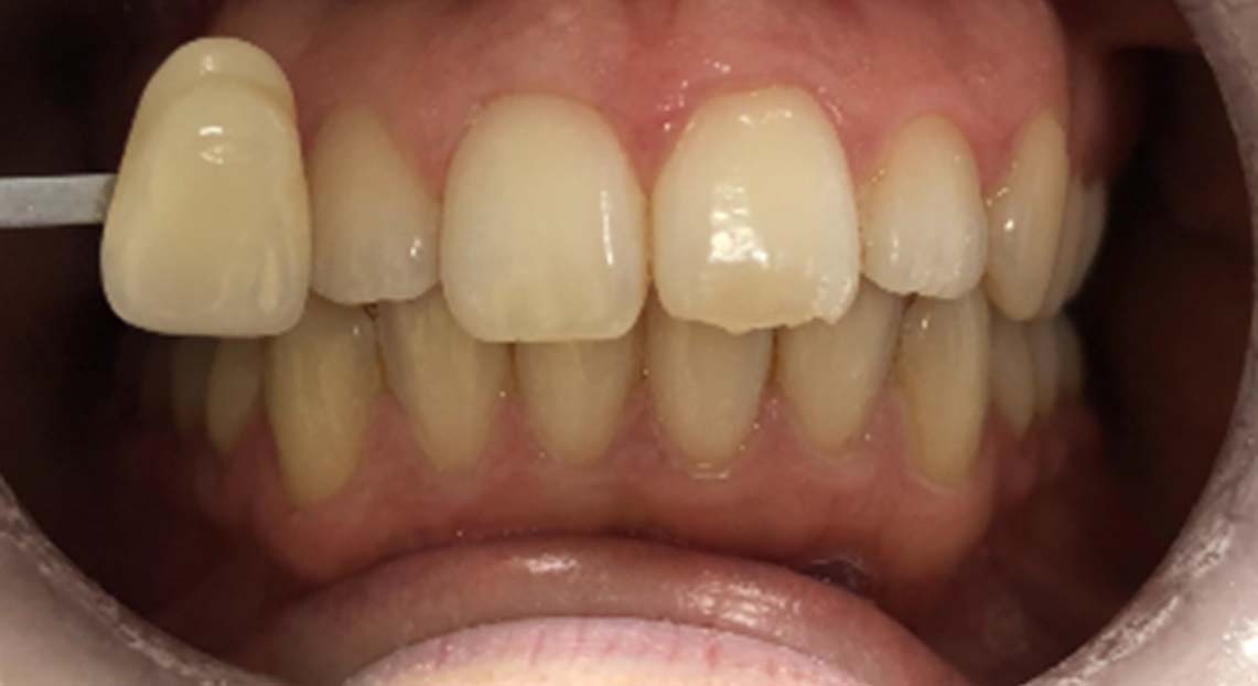 Before - Londent Dental