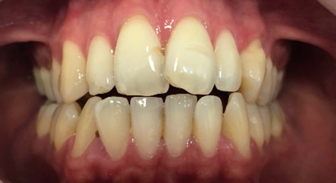 Before - Londent Dental