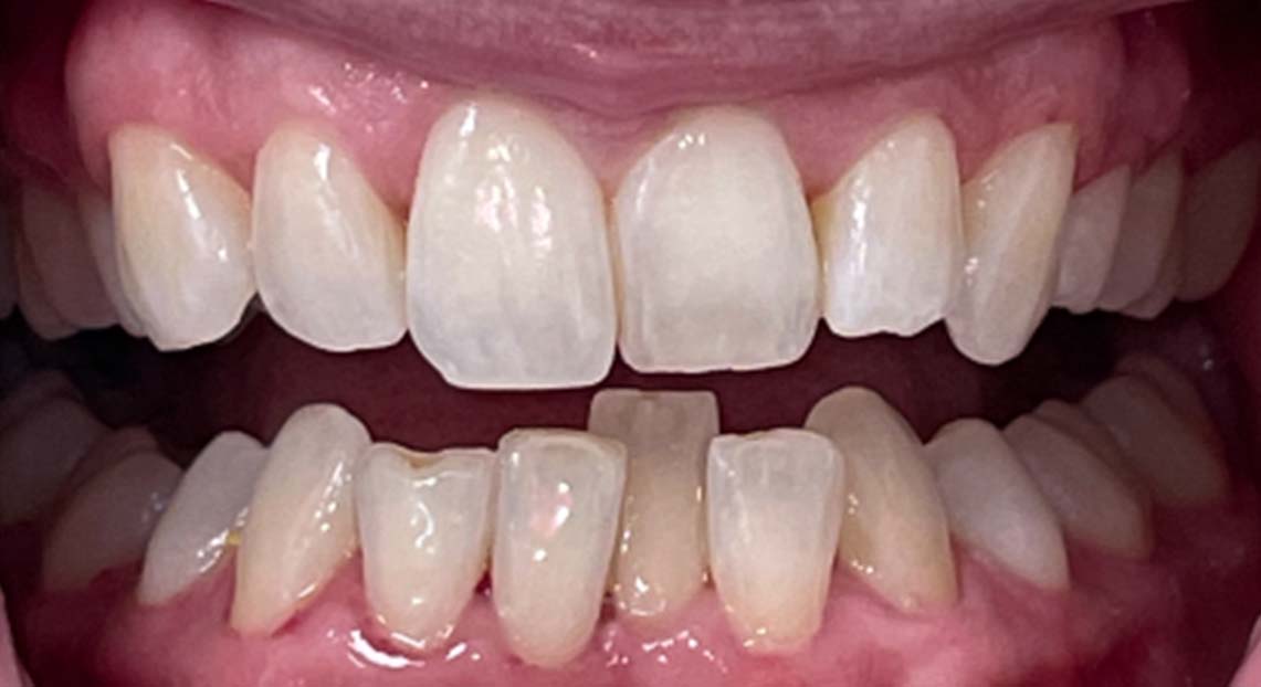 Before - Londent Dental