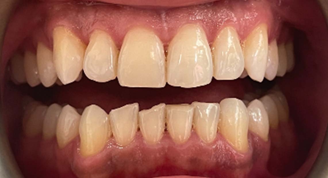 Before - Londent Dental