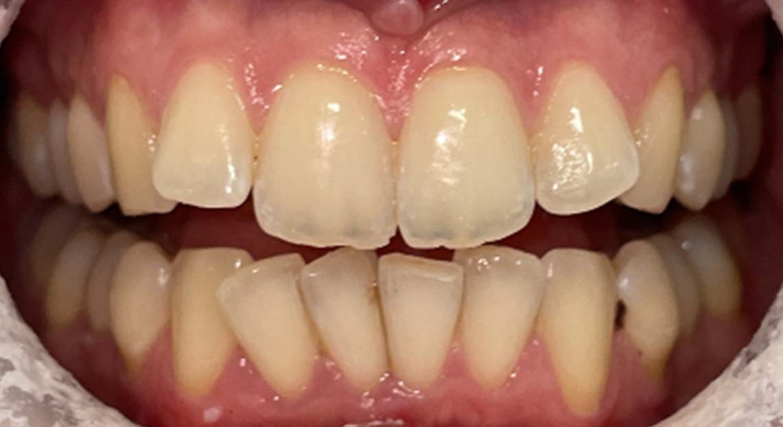 Before - Londent Dental