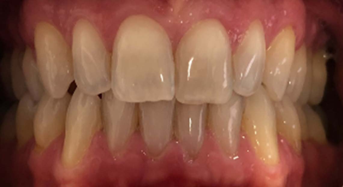 Before - Londent Dental